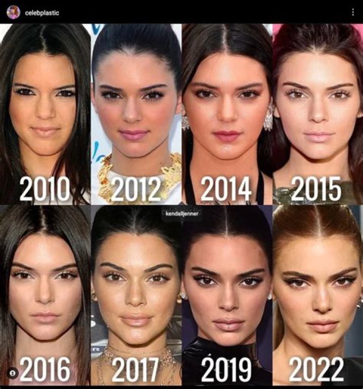 Kendall Jenner looks like she got more lip fillers (update: filter)