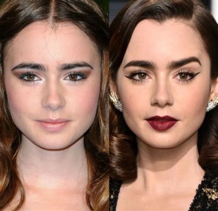 Lily Collins Nose Job: Before And After Photos
