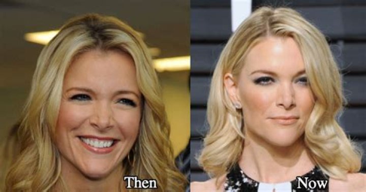 Megyn Kelly Facelift – Did She Get Plastic Surgery? Before And After Pics And Age