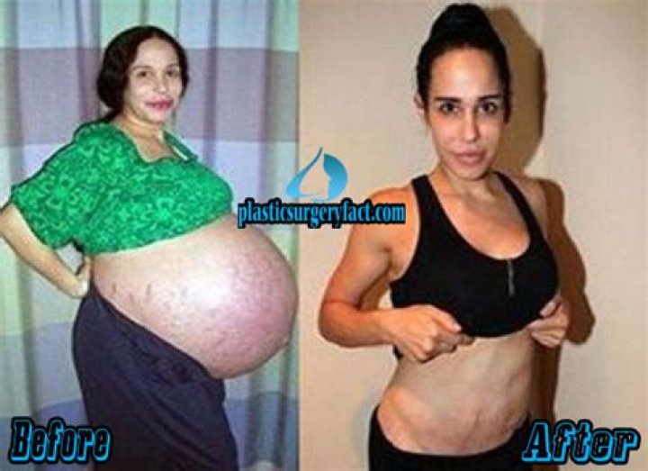 Nadya Suleman before plastic surgery; gets food stamps, child disability