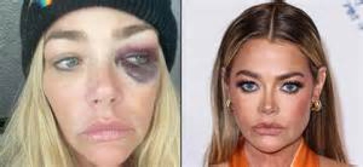 Tom Girardi Spotted With Black Eye in First Sighting Since Split